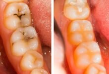 dental fillings Langley